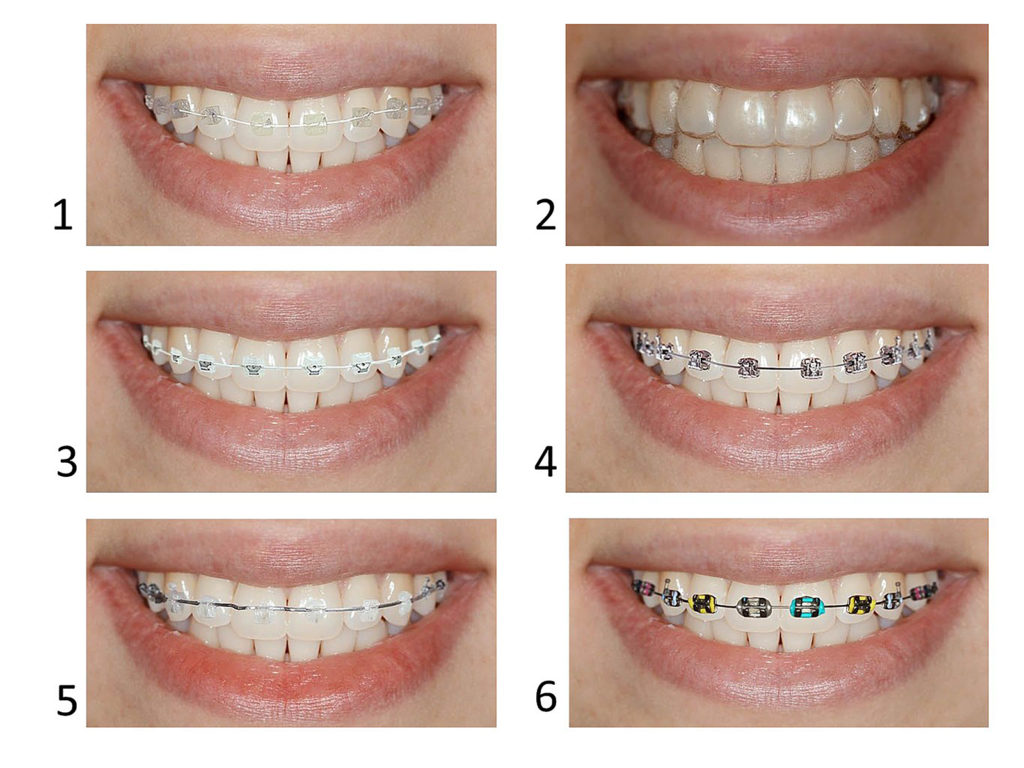 Types Of Braces- Pros And Cons Of Different Types Of Braces